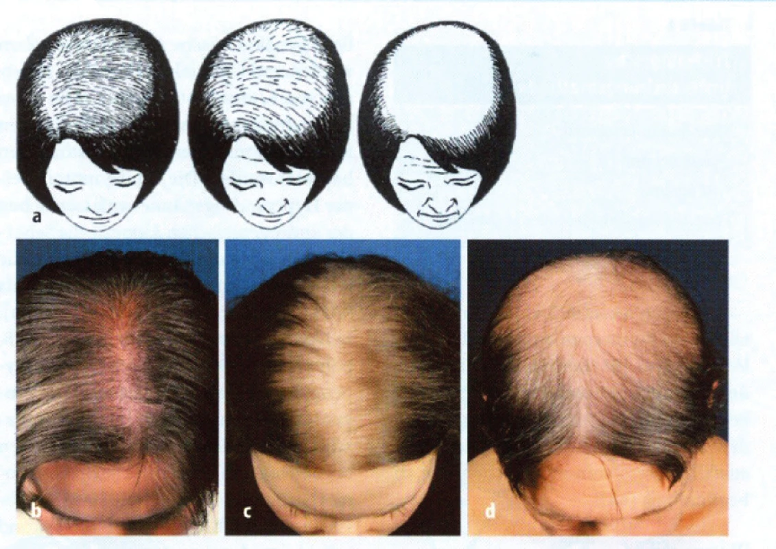 Třístupňová klasifikace ženské androgenetické alopecie podle Ludwiga