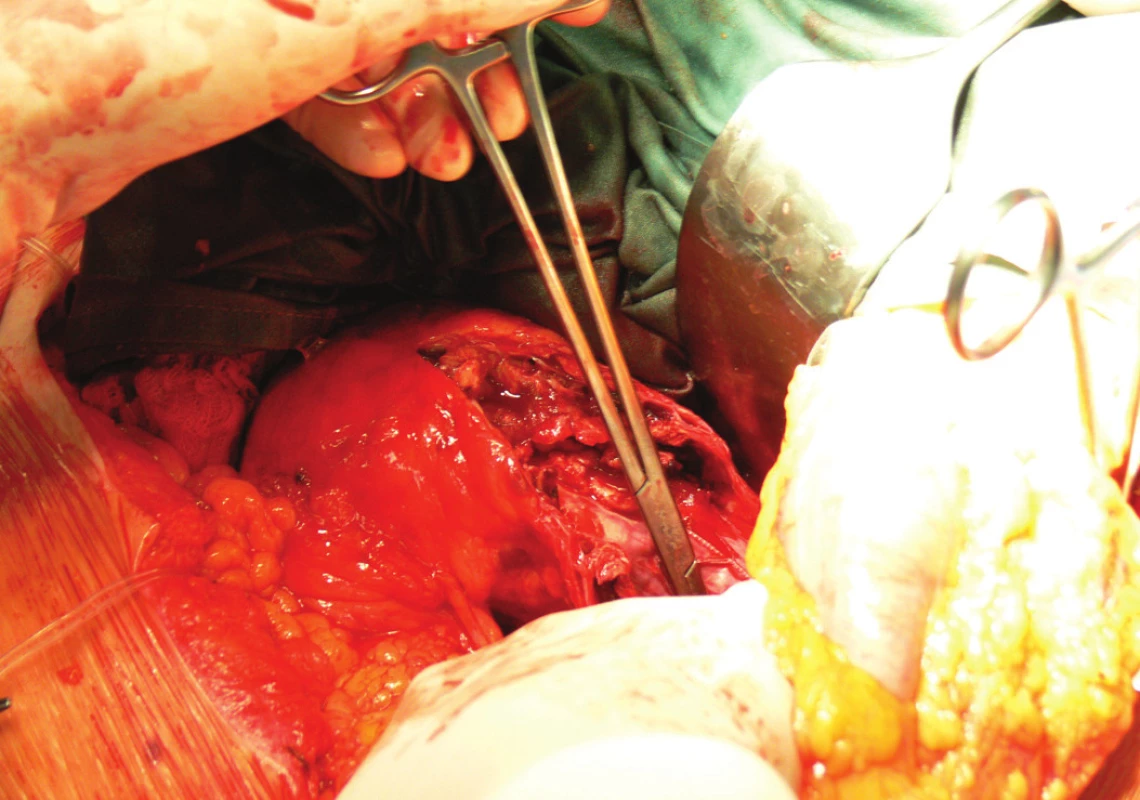Extrakce stentgraftu, subdiafragmaticky naložená aortální svorka
Fig. 10: An extraction of the stentgraft, a subdiaphragmatic laden aortic clamp