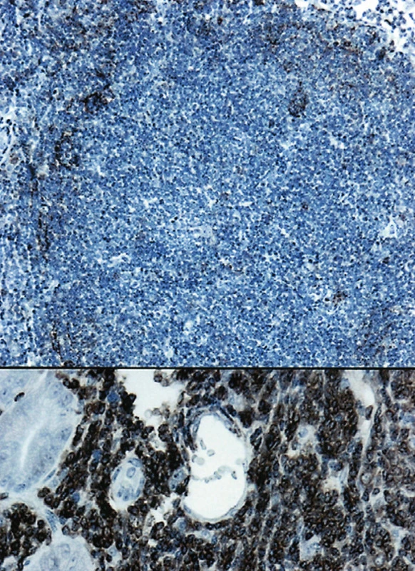 (a). Rozložení dendritických retikulárních buněk v nádorovém folikulu. (CD23, 50krát)
(b). V dolní části obrázku je pozitivní nález s protilátkou CD20 u FL. (400krát)
