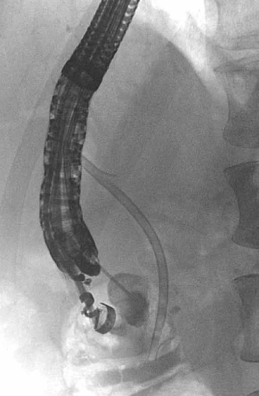 EUS – cystography during EUS-CDS in a patient with GP with a cyst in the duodenal wall and a stricture of distal common bile duct, plastic stent in the common bile duct (patient 4).
Obr. 6. EUS – cystografia počas EUS-CDS u pacienta s GP a cystou v stene duodéna a stenózou distálneho žlčovodu, plastikový stent v žlčovode (pacient č. 4).