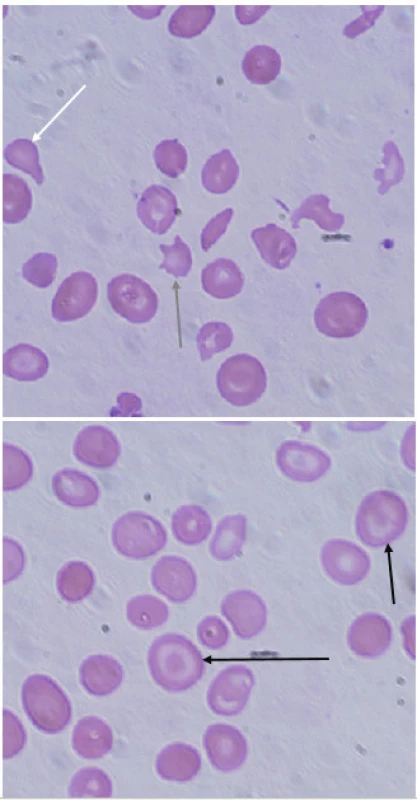 Typické nálezy v nátěru periferní krve u pacientky s β-talasémií major. V nátěru je patrná značná poikilocytóza, nacházíme četné terčovité erytrocyty (targetcells, černá šipka), ojediněle zachyceny slzičkovitý erytrocyt (dakryocyt, bílá šipka) a akantocyt (šedá šipka). (A. Lapčíková, Hemato-onkologická klinika, FN a LF Univerzity Palackého v Olomouci)
Fig. 3. Typical findings in peripheral blood smear in a patient with β-thalassemia major. Peripheral blood smear demonstrates poikilocytosis, target cells (black arrow), rarely dacryocyte (white arrow) and acantocyte (grey arrow).