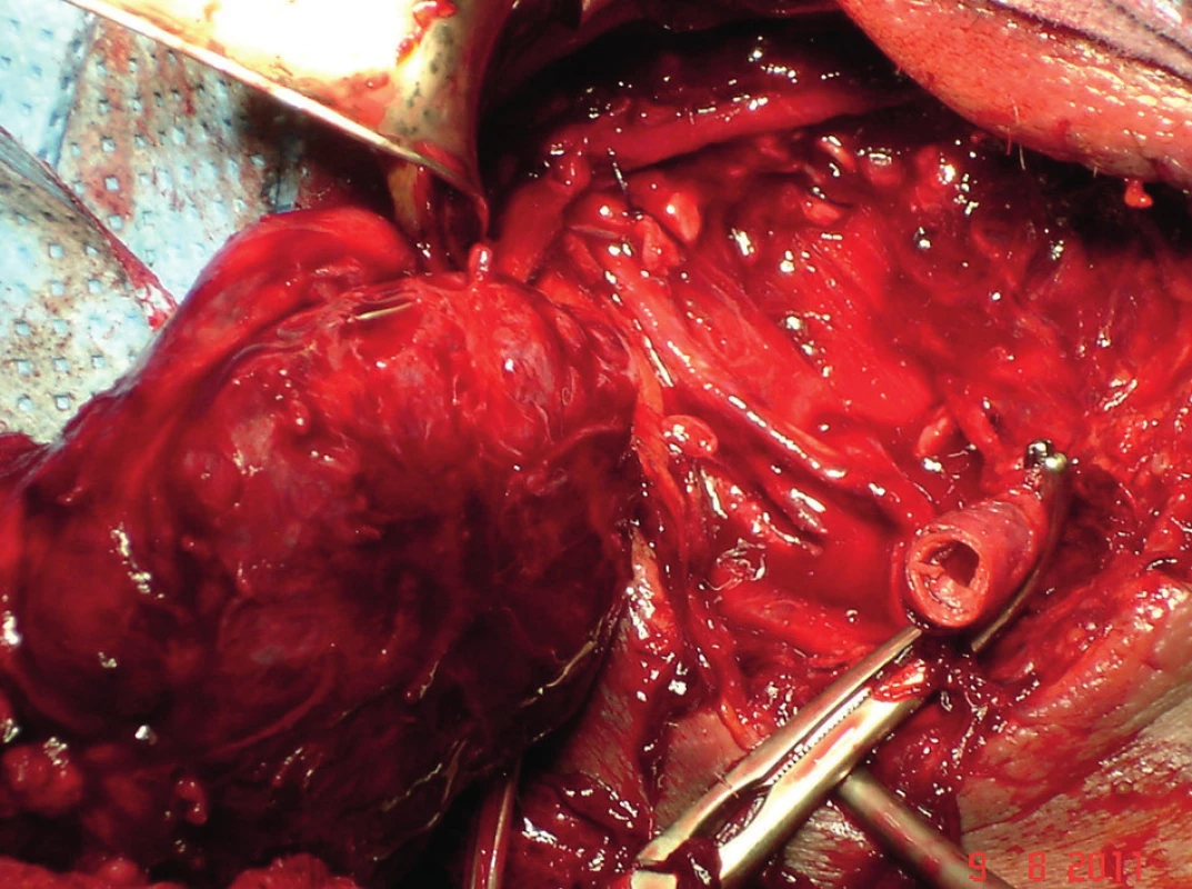Zvednutí celého tumoru po přetnutí ACC
Fig. 4: Lifting of the whole tumour after cutting the ACC
