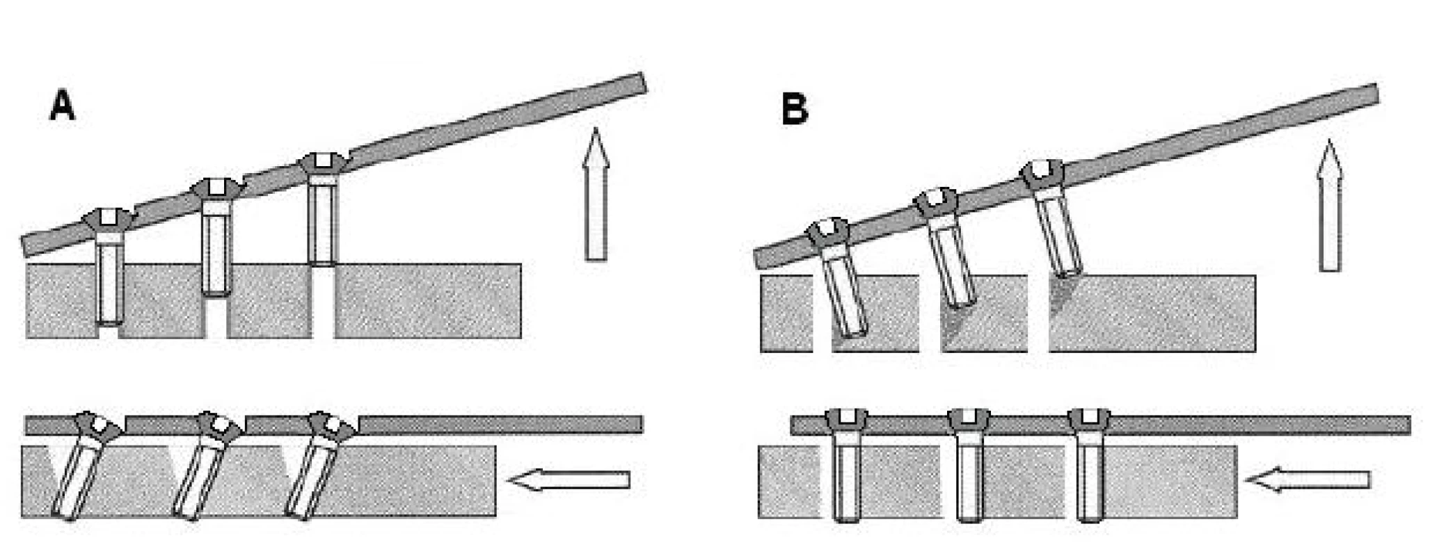Selhávání šroubů u klasické dlahy (A) a u LCP (B) u axiálního a ohybového namáhání implantátu