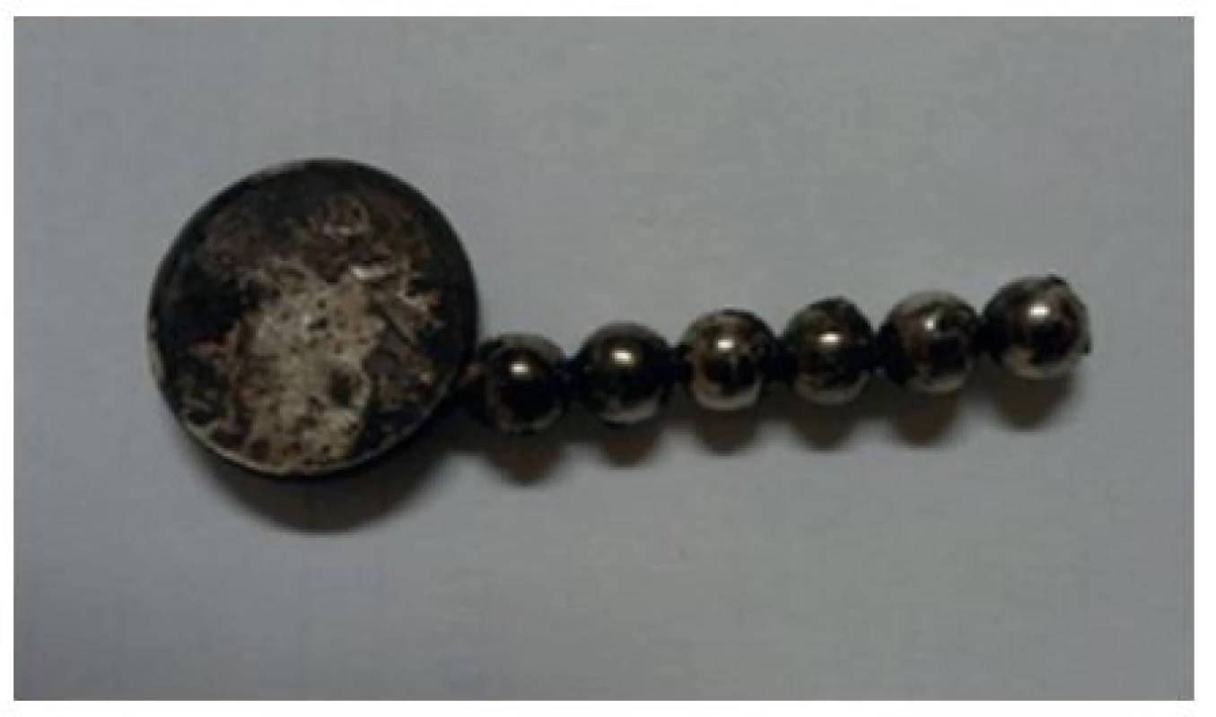 Cizí tělesa z ilea
Fig. 3: Removed magnetic balls and a metal body