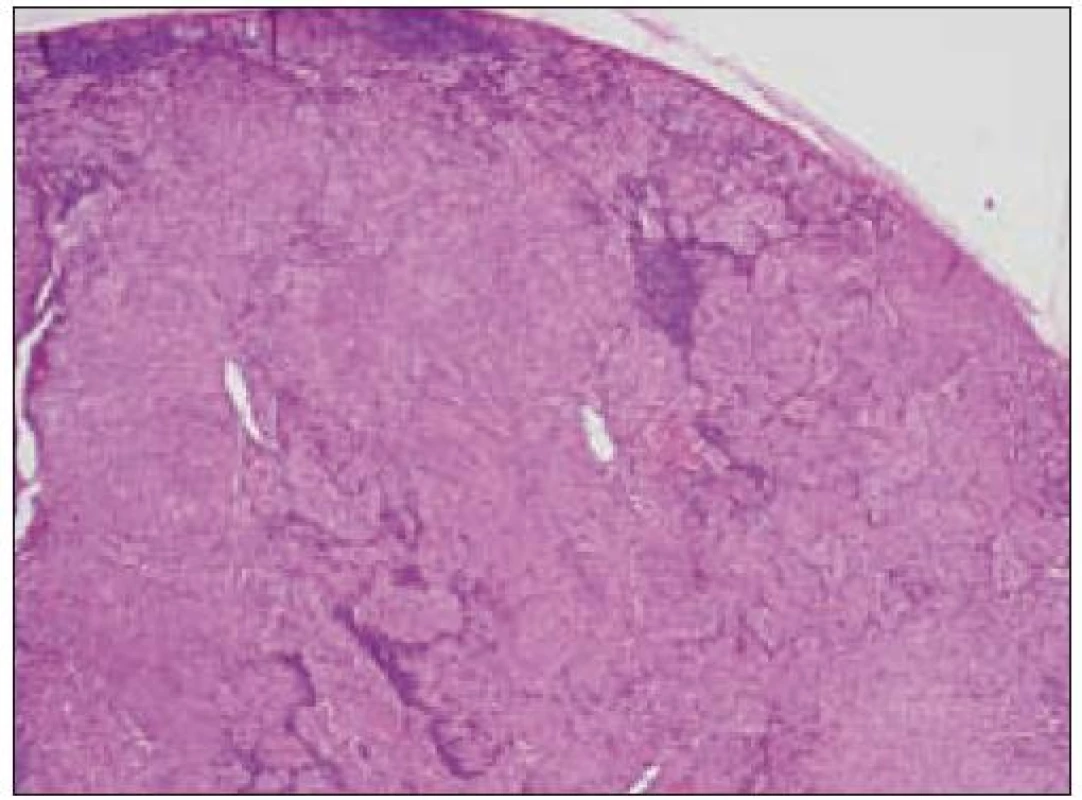 Histiocytový sarkóm, infiltrácia lymfatickej uzliny (HE, 4krát).