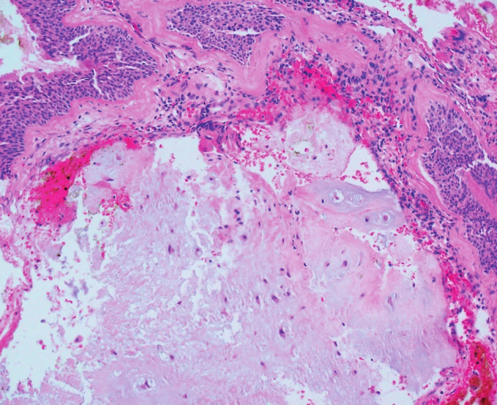 Histologie - ložiskovitě buněčnější chondrogenní nádor, jehož buňky vykazují jaderné atypie místy až se zdvojením jader, který proniká až do subepiteliální části sliznice, HE.