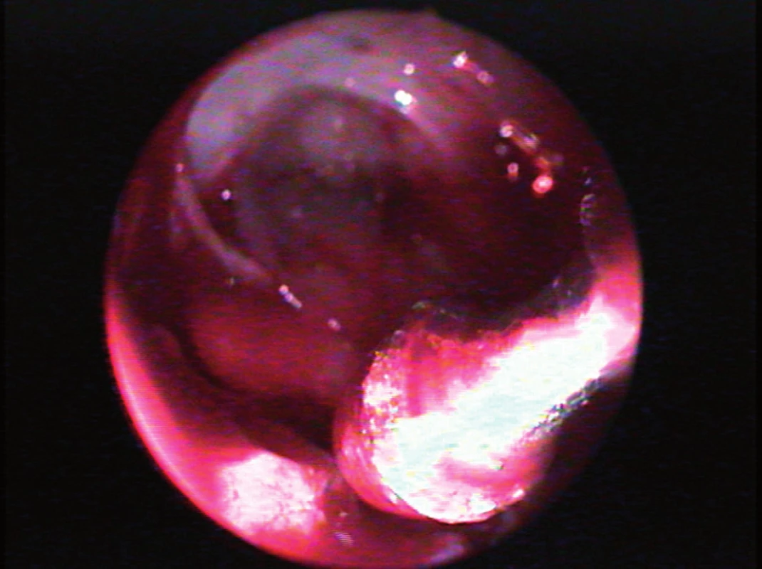 Transseptální přístup, optika 45°. Hyperostóza v místě inzerce tumoru, na rozhraní spodní a přední stěny pravého maxilárního sinu, je snášena frézou.