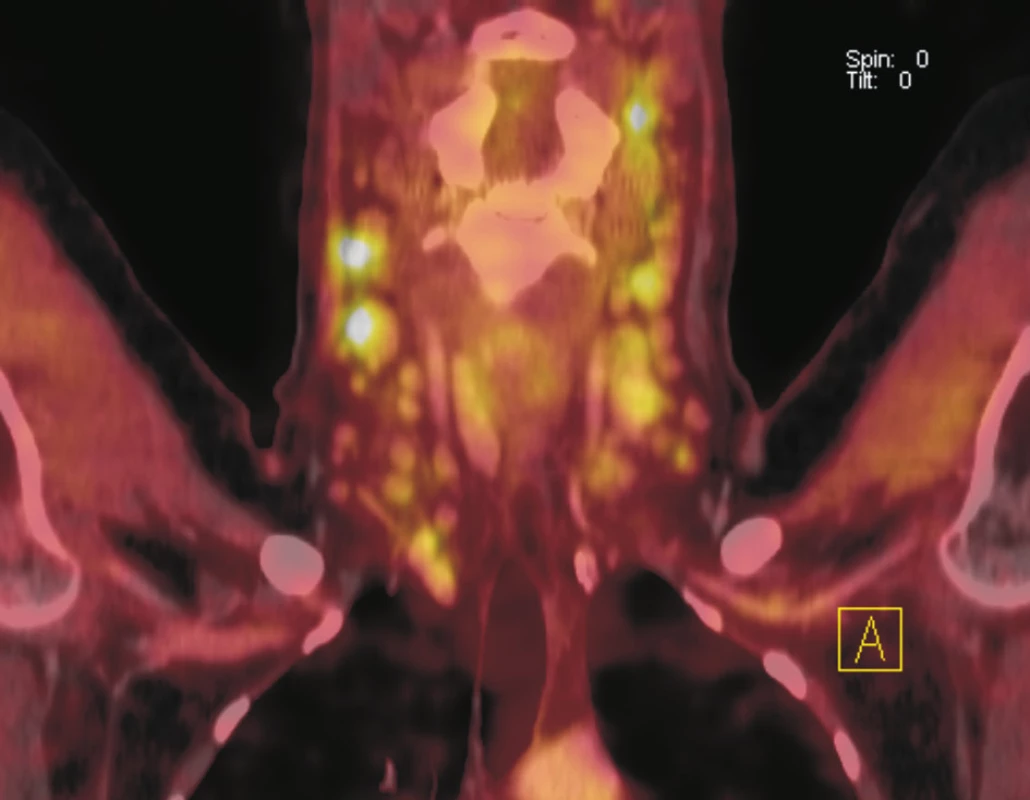 Fúze PET a CT řezů v koronální rovině. Na krku je v lymfatických uzlinách oboustranně patrná zvýšená akumulace &lt;sup&gt;18&lt;/sup&gt;F-FDG. Největší uzlina vpravo dosahuje velikosti 15x13 mm, vlevo 16x13 mm. Biopticky ověřena reaktivní lymfadenitida u imunosuprimované nemocné po imunochemoterapii a autologní transplantaci krvetvorných kmenových buněk pro relabující lymfom.