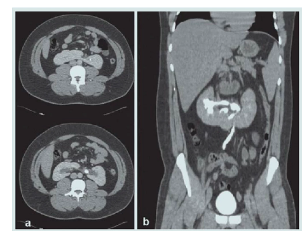 Abdominální CT.
A – Příčný řez ukazuje 20mm a 8mm konkrementy v pánvičce levé části podkovovité ledviny.
B – Koronární řez ukazuje podkovovitou ledvinu a jediný zkřížený močovod naplněný kontrastní látkou