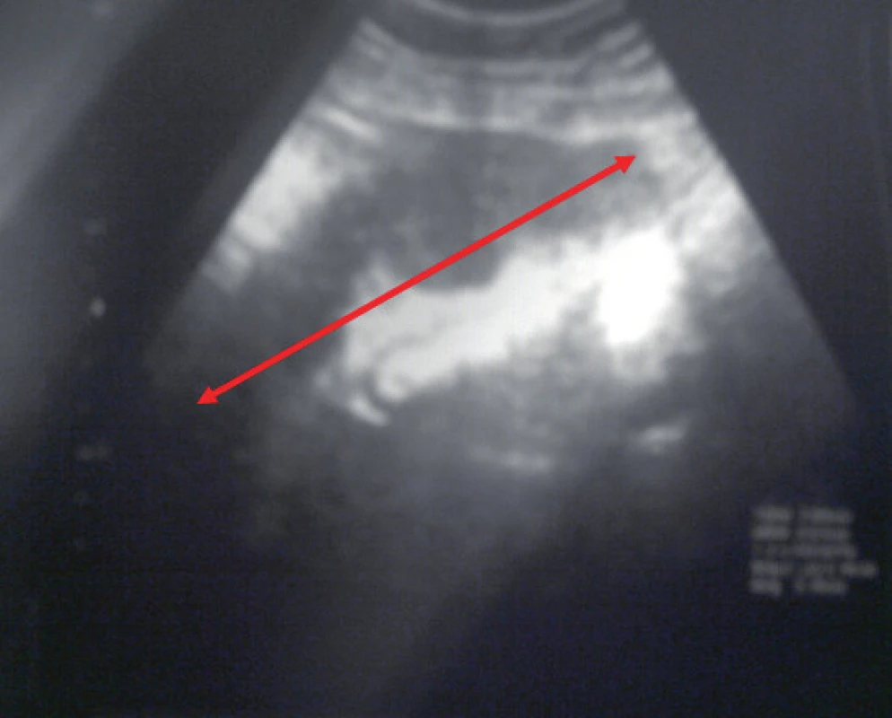 Ultrazvukový nález při příjmu pacientky. Vlevo od dělohy detekována tato setřelá, ne zcela ohraničená hypoechogenní struktura velikosti 70 × 50 × 50 mm.