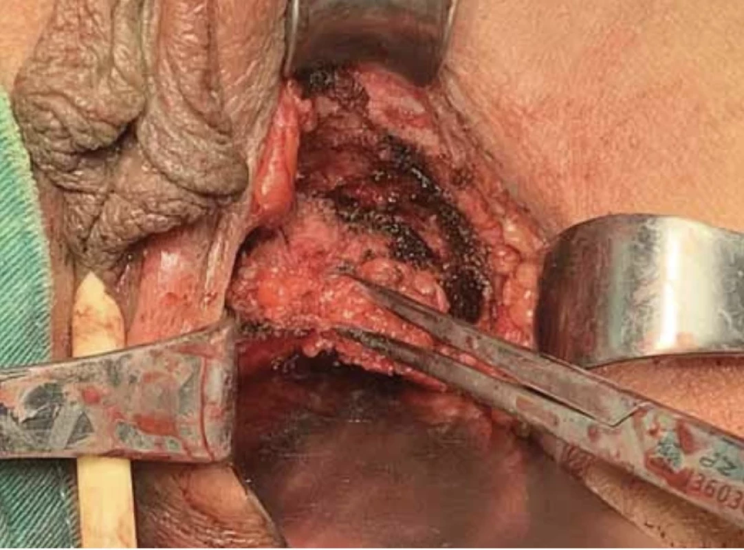 The solid nodule is located approximately 1.5 cm deep in the subcutis of the left inferior ramus of the pubis. // Pevná uzlina se nachází v asi 1,5 cm hlubokém podkoží levého dolního ramene stydké kosti.