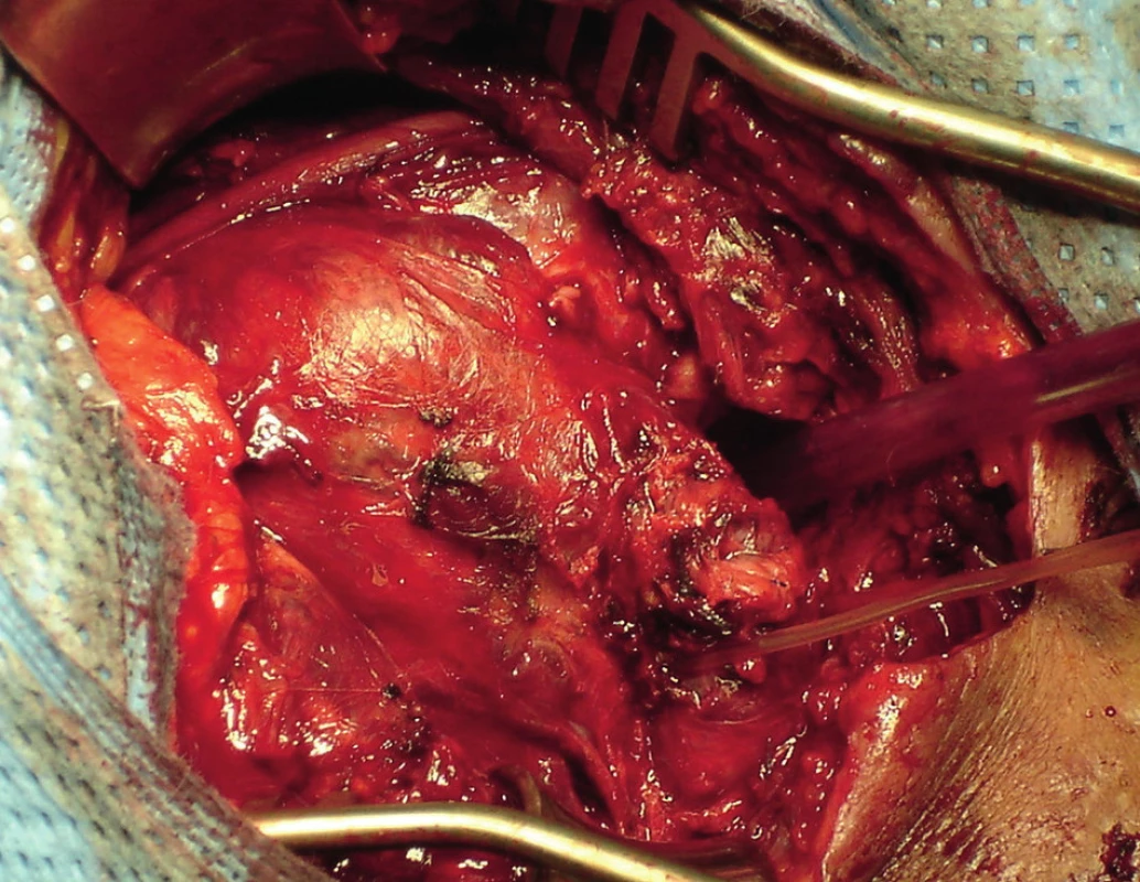 Velký prokrvácený tumor, v dolním pólu zajištěna ACC, která je arteficiálně prošita
Fig. 3: A large bleeding tumour, secured ACC in the lower pole which is artificially closed