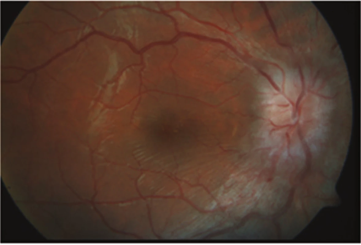 Zlepšující se nález s ustupujícím edémem terče zrakového nervu na pravém oku 
po několika týdnech léčby