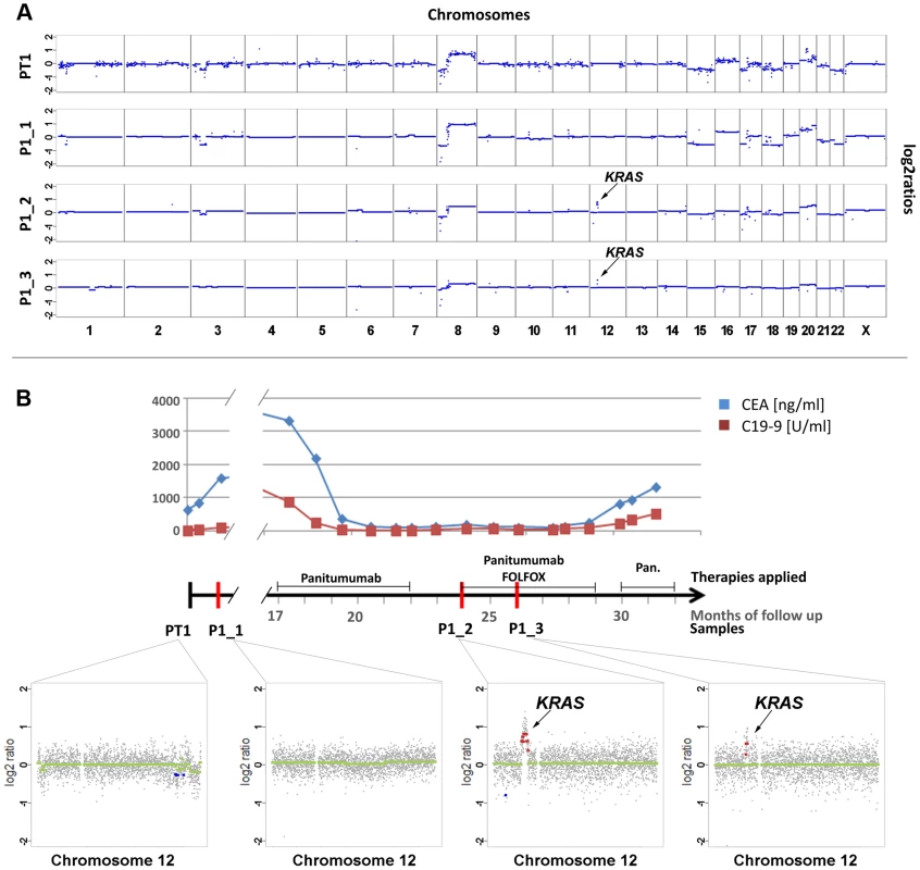 Emergence of <i>KRAS</i> amplification during panitumumab therapy in patient #1.