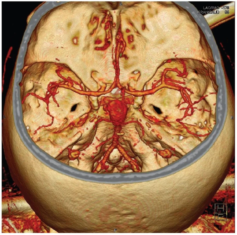 Gigantická výduť v terminální oblasti bazilární tepny na CT angiografii
Fig. 1: Giant aneurysm of the basilar tip on CT angiography