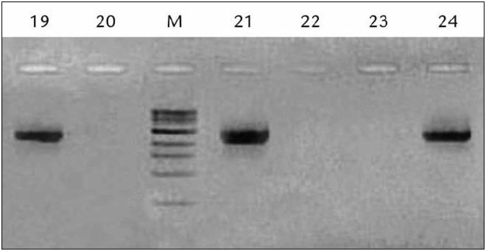 Ukážka vyhodnotenia výsledkov RT‑PCR reakcie pre PSA pred RP pomocou gélovej elektroforézy.