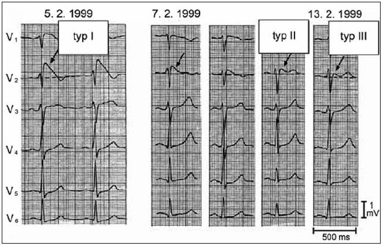 Jednotlivé typy EKG obrazu zaznamenané u pacienta s Brugada syndromem během několika dní. S dovolením převzato z citace [13].
