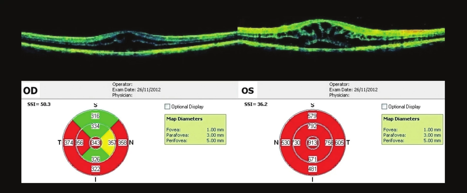 OCT makul OPL – vstupní nález
CME OPL – Oboustranně difúzní ztluštění neurosenzorické sítnice a snížení reflexivity celé sítnice v souladu s cystickou přestavbou, linie RPE kontinuální