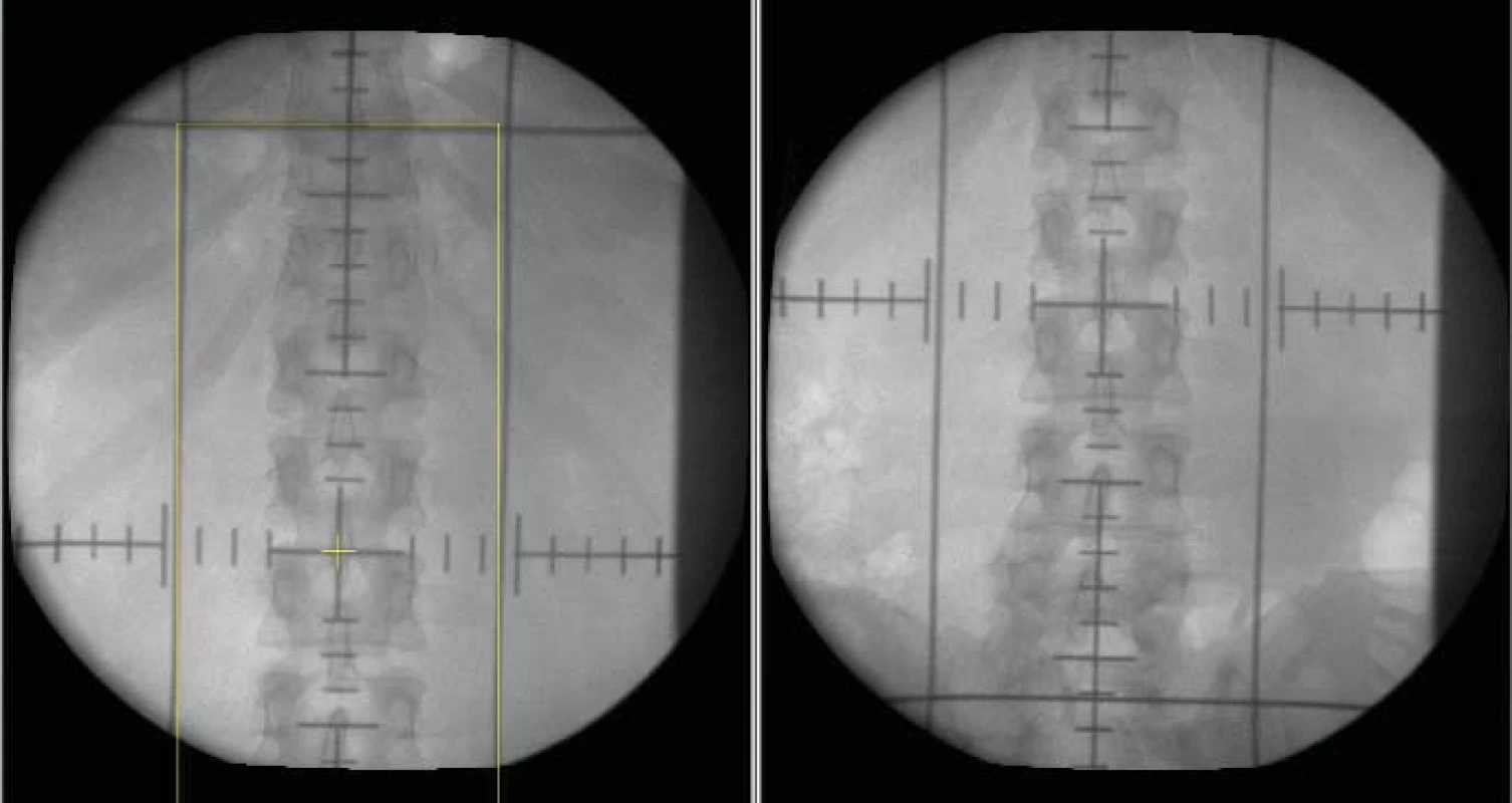 Simulační snímky adjuvantní radioterapie oblasti paraaortálních břišních uzlin u pacienta se seminomem klinického stadia I (kraniální a kaudální hranice protilehlých polí).