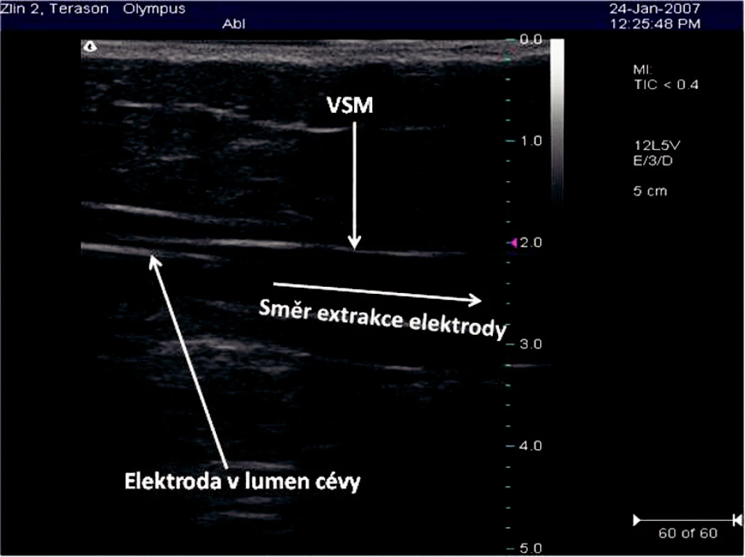 Elektroda RFITT zavedená do VSM v sono obraze
Fig. 3. Ultrasound view of a RFITT electrode introduced info the VSM
