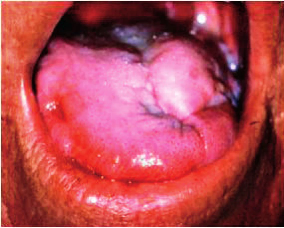Prechod erytematóznej formy kandidózy do pseudomembranóznej formy na povrchu jazyka. Okraje jazyka od tvorby pseudomembrán sú zatiaľ ušetrené (Ďurovič)