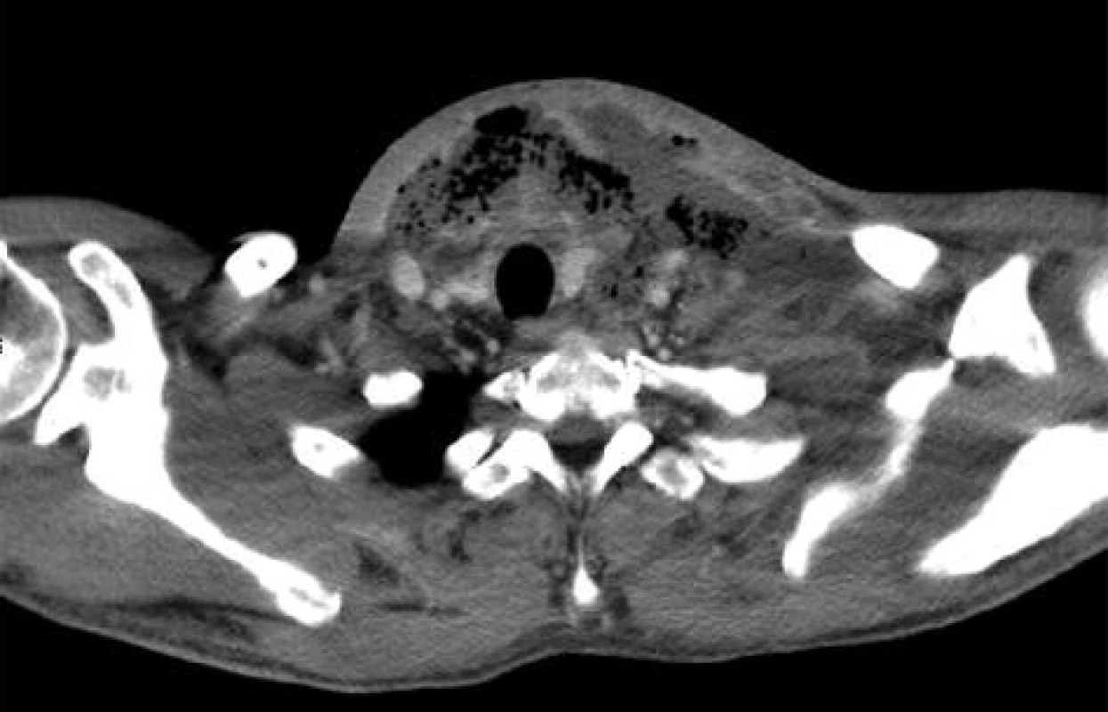 CT obraz – rozsáhlý absces na levé straně a ventrálně na krku
Fig. 2: CT image – a large abscess of the left and ventral part of the neck