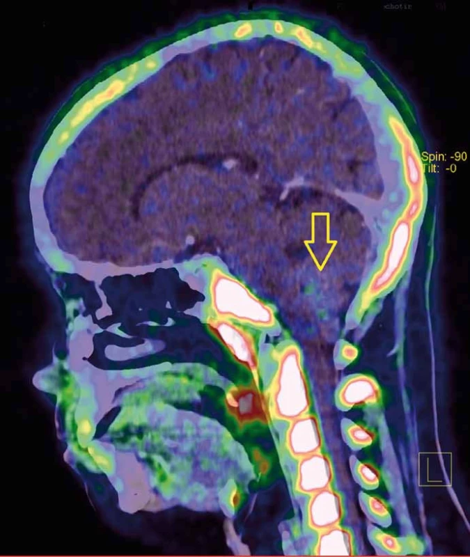 PET/CT s FLT (fluorothymidin) ukazuje proliferačně aktivní tumor s nevýraznou akumulací radiofarmaka.