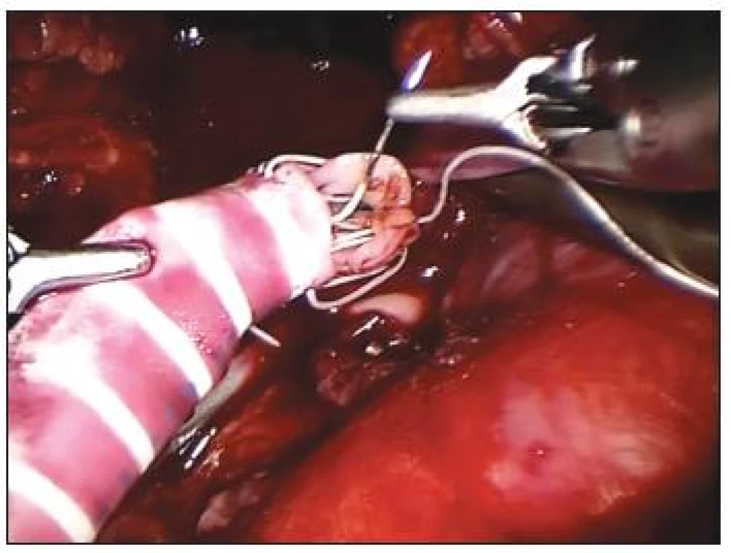 Iliakorenální bypass, anastomóza mezi PTFE protézou a renální tepnou
Fig. 4. Iliaco-renal bypass, anastomosis between the PTFE prosthesis and the renal artery