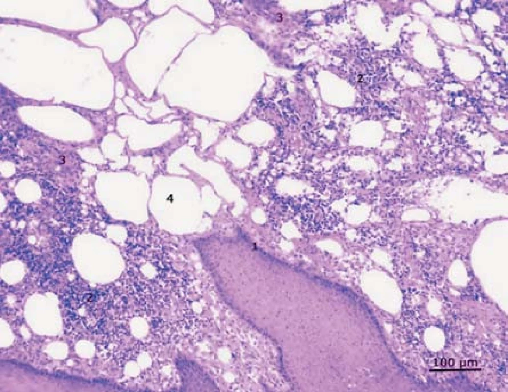 Tkáň prepucia získaná peroperčaně u pacienta po injekční aplikaci borové masti: epidermis (1), lymfocytární infiltrát (2), s četnými makrofágy. Zastiženy také mnohojaderné buňky typu z cizích těles, granulomatózní tkáň (3) a četné tukové vakuoly (4). Barvení hematoxylin-eosin, zvětšeno 100x.
Fig. 5. Tissue of the prepucium obtained peroperatively after the injection aplication of the boric ointment in the past: epidermis (1), lymphocytic infiltrate (2), with macrophages, foreign-body-type multinucleated giant cells, granulation tissue (3) and numerous fat vacuoles (4). Haematoxylin-eosin, magnification 100x
