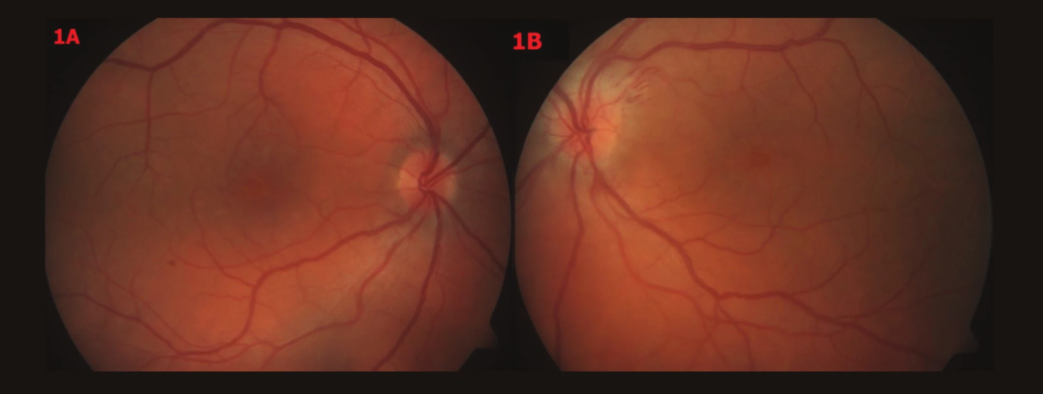 Barevné fotografické snímky fundu OPL – vstupní nález
1A – OP – papila okrouhlá, ohraničená, růžová, v centru CME,
1B – OL – papila neostře ohraničená, prosáklá, bledší než vpravo, lehce nad niveau, parapapilárně třískovité hemoragie u č. 2, v centru CME, oboustranně artérie užší, tvrdších reflexů, vény vinuté, dilatované, oboustranně ve střední periférii ojediněle tečkovité hemoragie