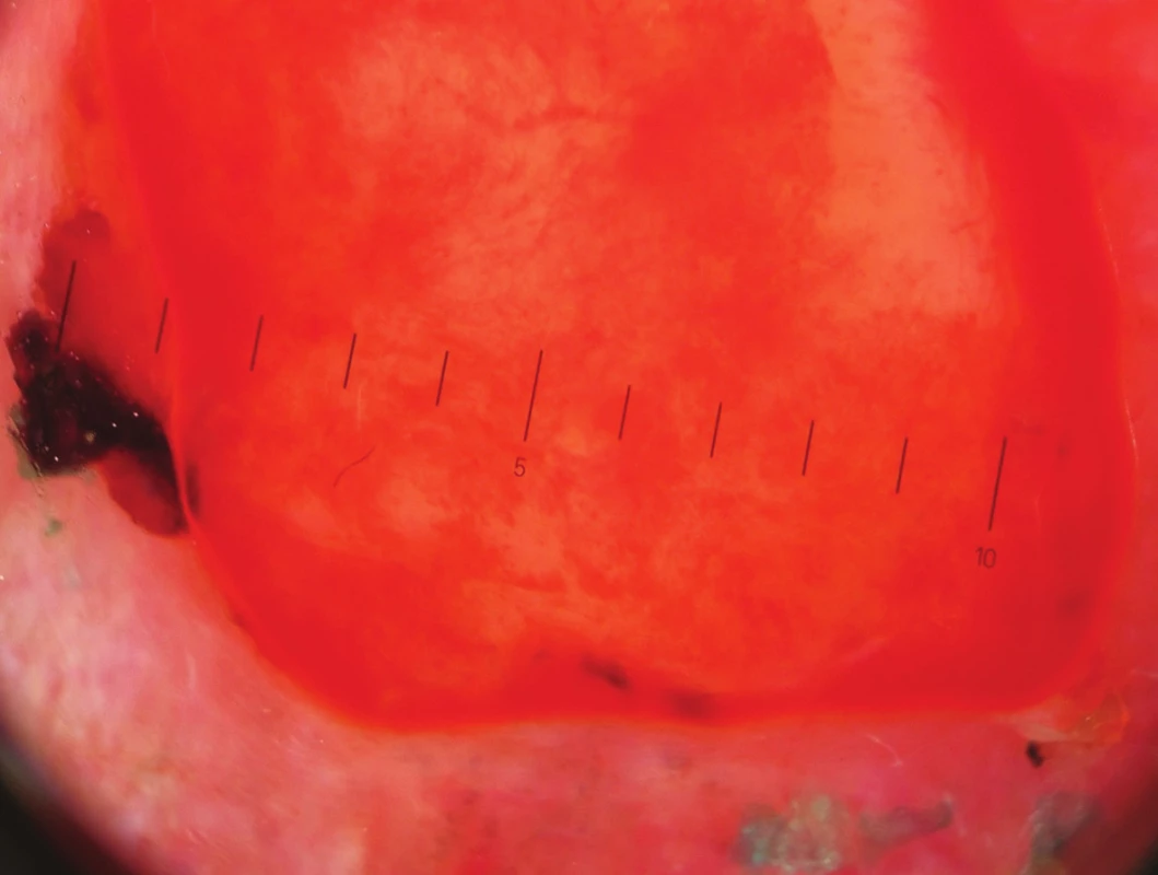 Dermatoskopický nález AFX – světlečervená bezstrukturní plocha s bělavými okrsky, silné cévy, místy arboriformně se větvící