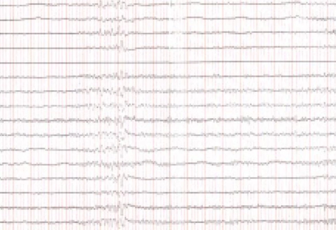 EEG v septembri roku 2006 – ojedinele τ-aktivita – obraz len miernej abnormality.
