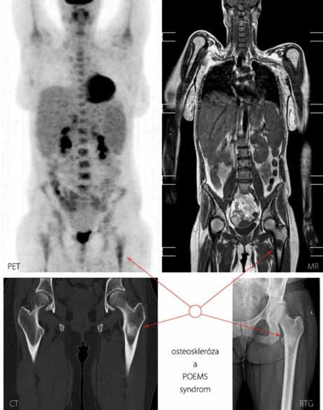 Součástí diagnostických kritérií POEMS syndromu je i průkaz osteosklerotického ložiska. Zde vyobrazeno sklerotické ložisko v oblasti proximální části kosti stehenní vlevo u případu 7 metodami PET, MR (magnetická rezonance, T1 vážená sekvence), CT a konvenční radiografií.
