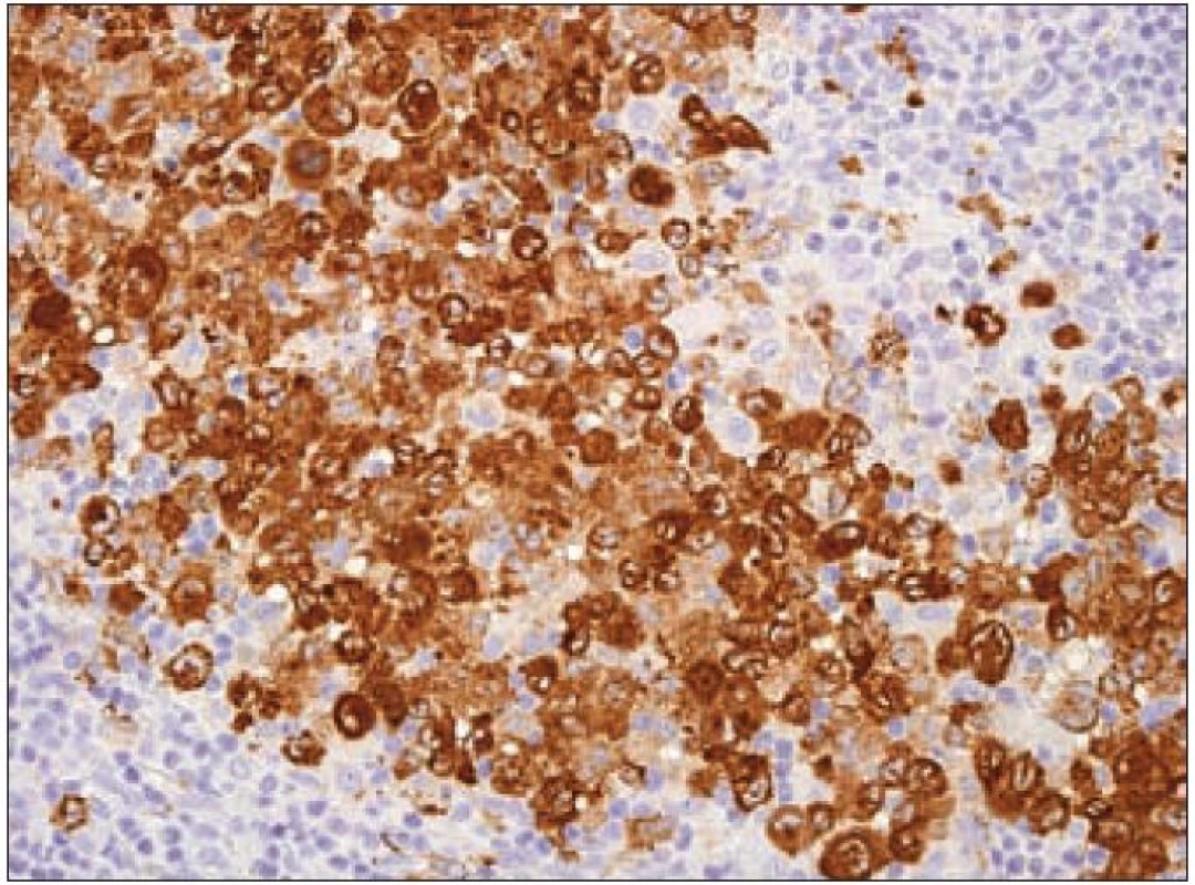 Langerin (CD207) – imunohistochemické vyšetření. Cytoplazmatická výrazně granulární pozitivita Langerhansových buněk (hnědý precipitát), jádra dobarvena hematoxylinem.