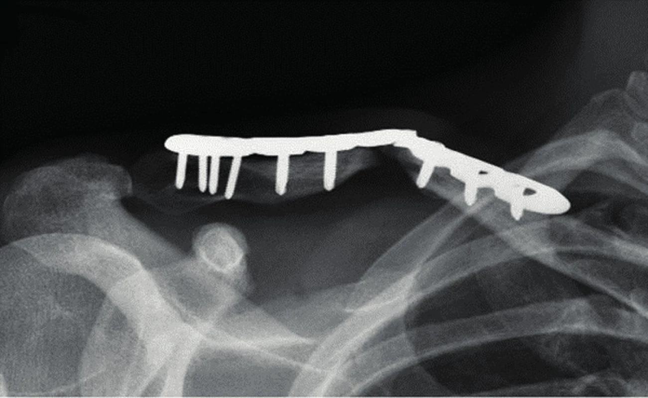 Zlomení zamykatelné dlahy při rozvoji pakloubu klíční kosti v odstupu devíti měsíců po operaci (muž, 36 let)