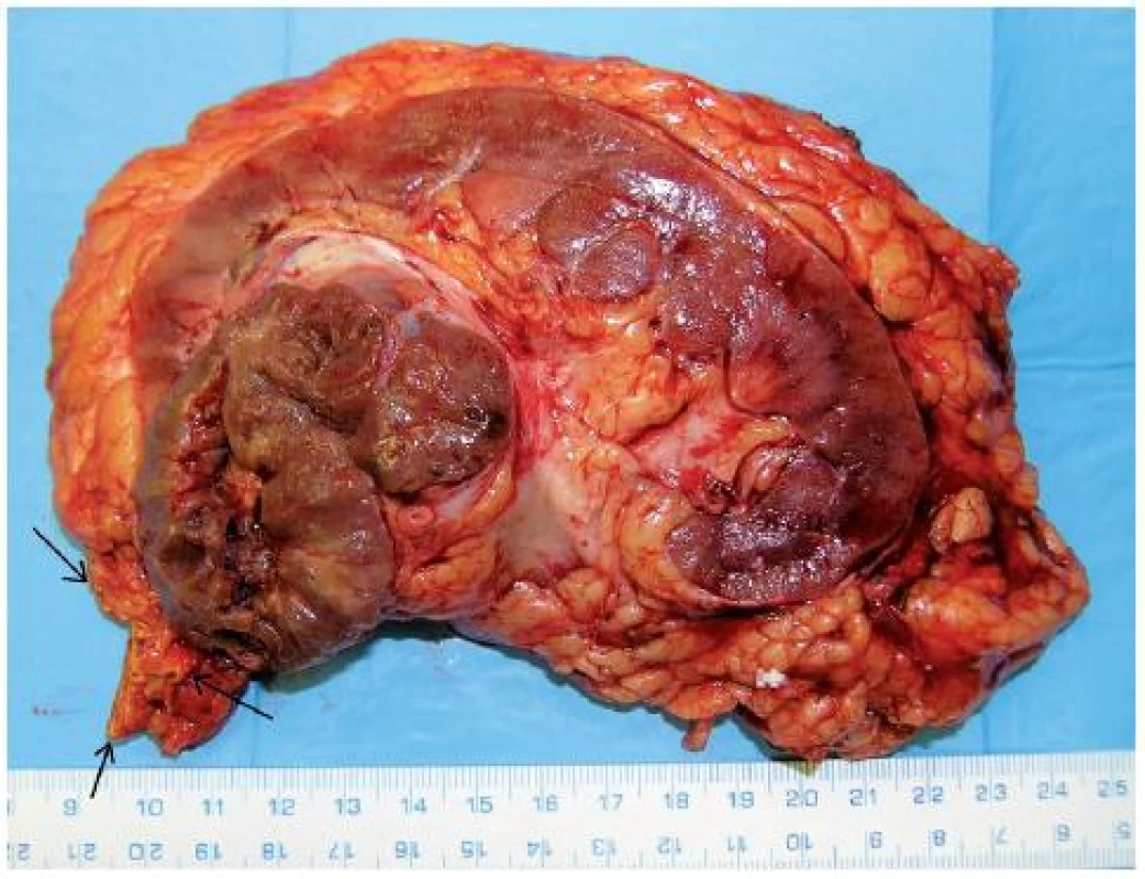 Onkocytický papilární renální karcinom (21) horního pólu pravé ledviny T3aN0M0 u 76letého muže, provedena nefrektomie s adrenalektomií (tumor naléhal na nadledvinu – na preparátu nadledvina označena šipkou) 
Fig. 7. Oncocytic papillary RCC (21) of upper pole of the right kidney T3aN0M0 in a 76-year-old-man. Nephrectomy with adrenalectomy performed (arrows show adrenal gland related to tumour).