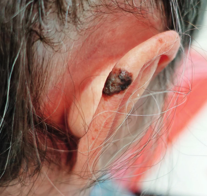 Superficially spreading melanoma of the right ear