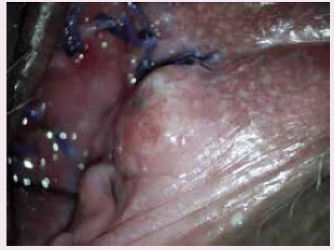 Recidiva melanomu v oblasti levého malého labia