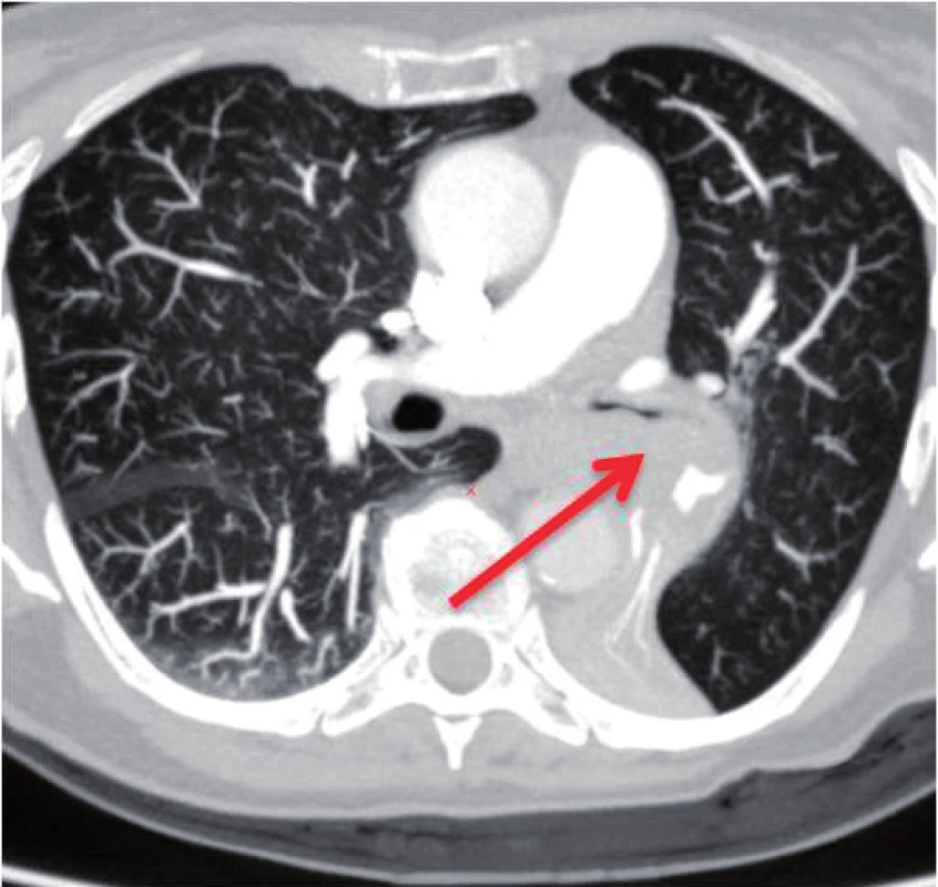 Šedesátiletá pacientka vyšetřena pro dušnost, odeslána k vyloučení plicní embolie. Při CT vyšetření nalezen tumor plic s útlakem levého bronchu.