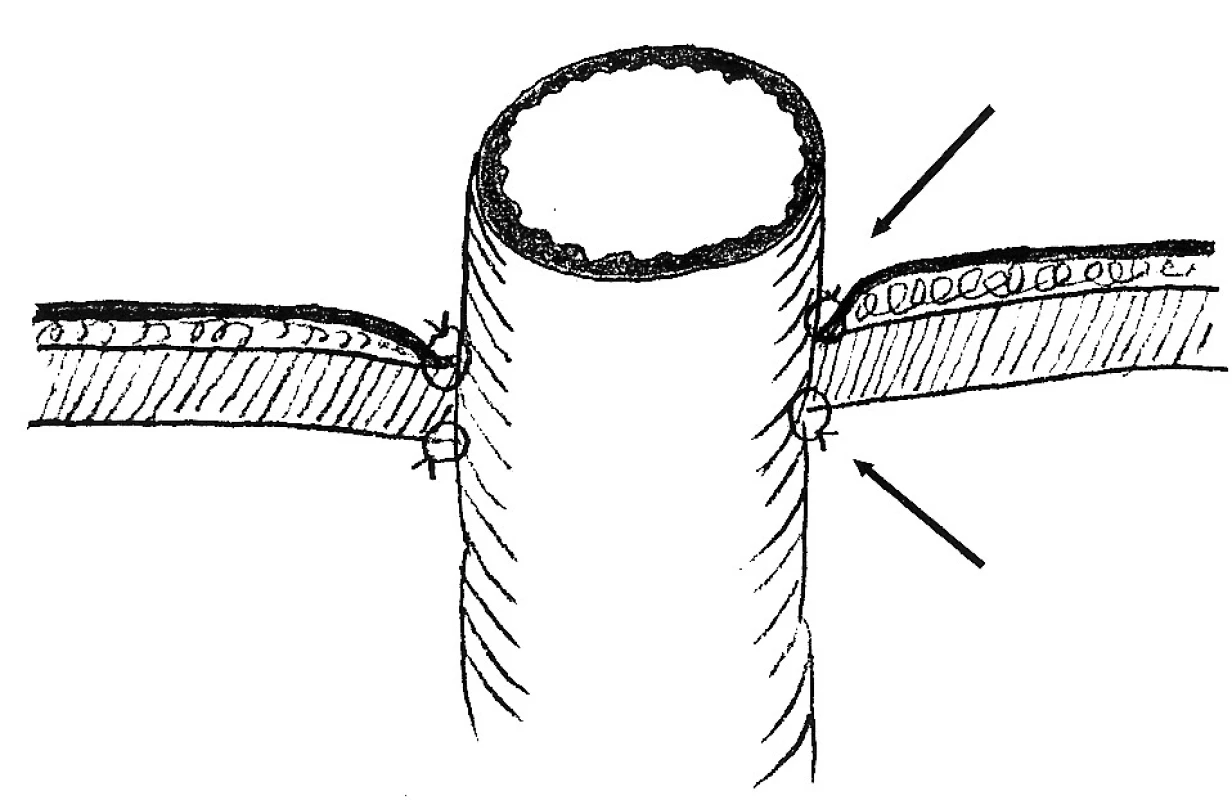 Schéma fixovania stomovaného čreva v kanáli brušnej steny
Fig. 7. A scheme of fixation of the undone intestine in the abdominal wall channel