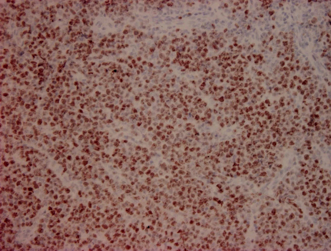 Ki67 200x. Výrazná proliferační aktivita nádorových buněk.