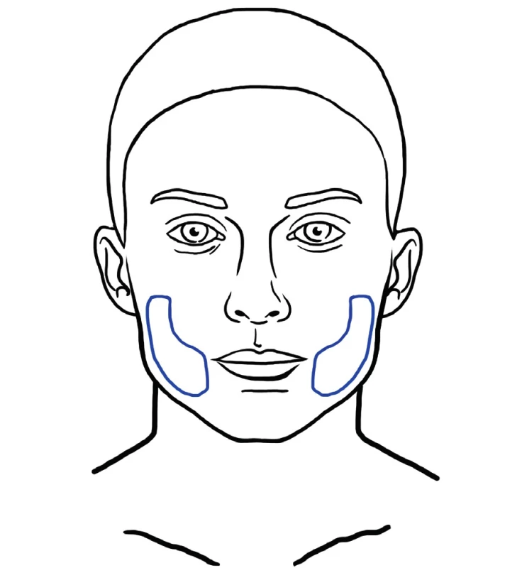 Areas for intradermal fat grafting usually involve the forehead, glabellar rhytides, nasolabial fold and perioral rhytides. SNIF technique can also be used for improvement of lip and philtrum contou
