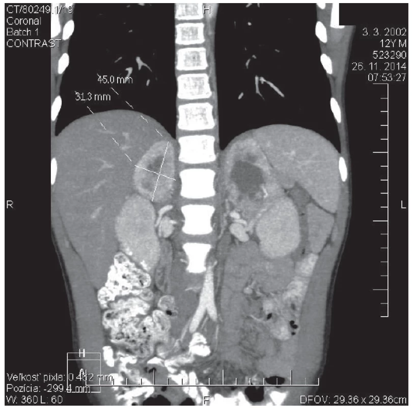 CT angio brucha s kontrastom u 12-ročného pacienta s potvrdeným VHL syndrómom. V oblasti pravej nadobličky prítomný tumorózny útvar veľkosti 45 x 31 x 30 mm. Obojstranne pomerne výrazné vysycovanie po podaní kontrastnej látky, v centrálnej časti hypodenzné rozpadové dutiny.
&lt;br&gt;&lt;b&gt;Fig. 1.&lt;/b&gt; Contrast CT scan of abdomen in 12 years old patient with confirmed VHL syndrome. In the place of right adrenal gland is present tumorous mass: 45 x 31 x 30 mm of size. Bilateral rather distinct enhancement after contrast is visible, with central area of low attenuation that represents necrotic cavities.