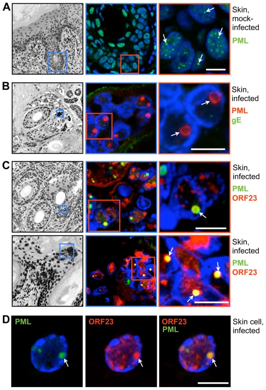 PML cages sequester VZV nucleocapsids during infection of human skin.