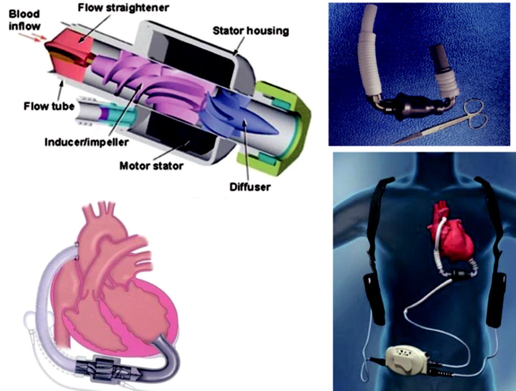 Implantovatelné mechanické podpory s kontinuálním průtokem
Vlevo – MicroMed DeBakey VAD; vpravo – systém Thoratec-HeartMate II