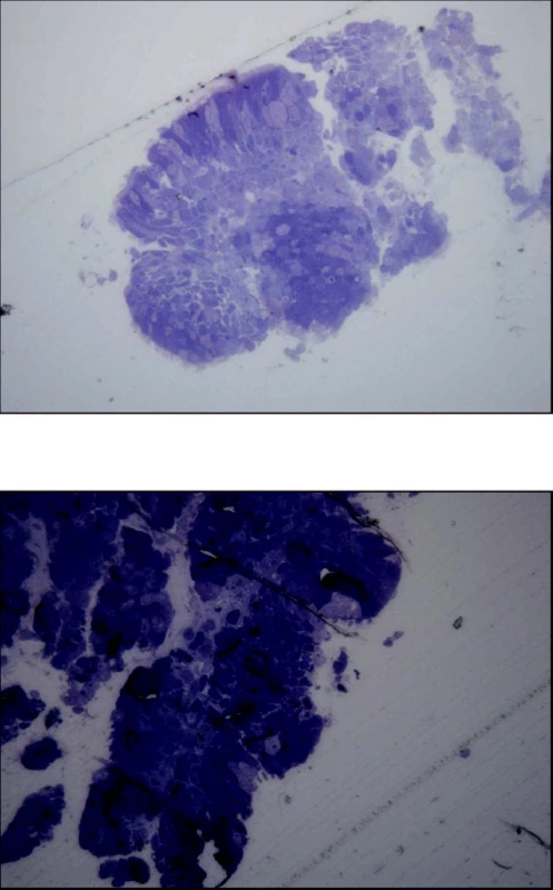 Řasinkový epitel a zmnožené pohárkové buňky u nemocného s lehčím stádiem CHOPN (A) a těžké destrukční změny povrchu řasinkového epitelu pacienta s těžkým stupněm onemocnění (B) (archiv autorů) 