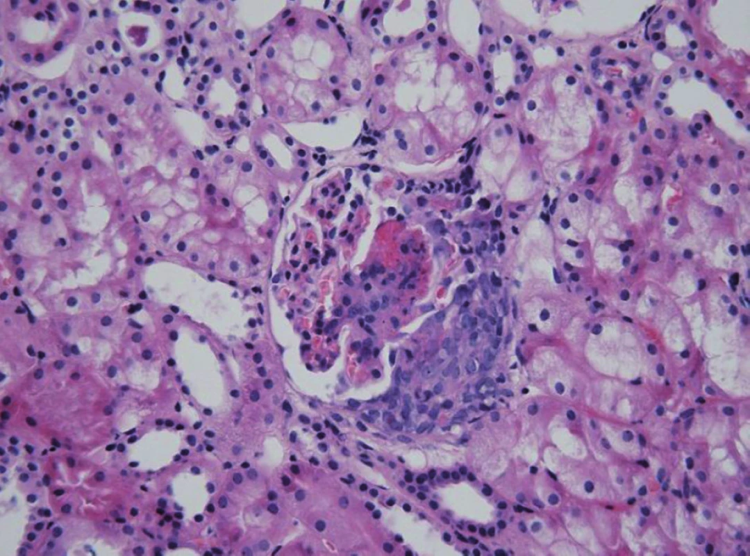 HSP nefritida. Přítomnost nekrózy a celulárního srpku v glomerulu u těžce probíhající formy HSPN.
Fig. 2. HSP nephritis. Glomerular necrosis and cellular crescent in severe HSP nephritis.