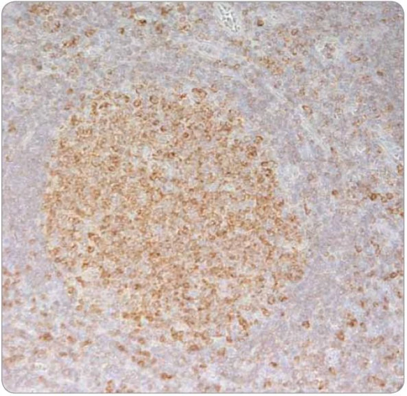 Imunohistochemický průkaz exprese Bcl-2 proteinu v lymfocytech v nádorových folikulech potvrzující diagnózu folikulárního lymfomu (2009; 400×).