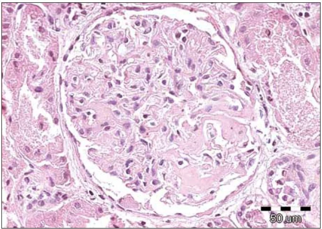 Renální amyloid vždy postihuje glomeruly, dále jsou obvykle zřetelná depozita ve stěnách cév, často v intersticiu a podél bazálních membrán. Amyloid má podobu homogenních depozit, které se barví světle růžově při rutinním barvení hematoxylin eozinem – jsou eozinofilní. Na obrázku je detail normocelulárního glomerulu s depozity eozinofilních bezstrukturních hmot v mezangiu u pacienta s AL‑ amyloidózou. Barvení  hematoxylin‑eozinem, původní zvětšení 200krát.