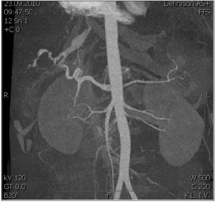 AngioCT snímek jater: Arteriovenózní píštěl po neoperačně léčeném poranění jater